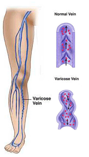 Varicose Vein