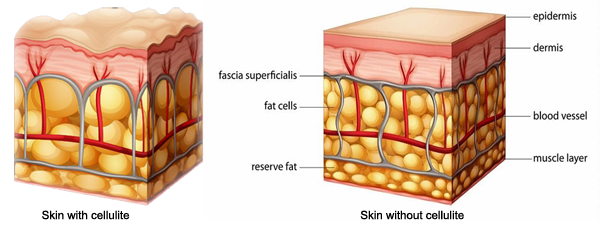 Skin cellulite Skin cellulite