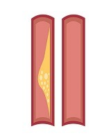 Atherosclerosis